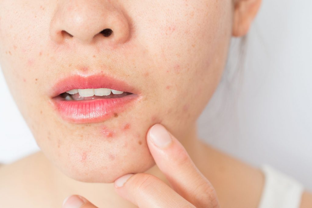 acne skin woman