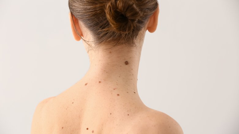 woman with moles on her neck and back